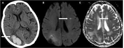 Remote diffusion-weighted imaging lesions and blood pressure variability in primary intracerebral hemorrhage